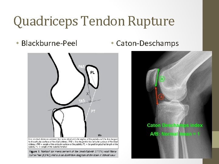 Quadriceps Tendon Rupture • Blackburne-Peel • Caton-Deschamps Quadriceps Tendon Rupture • Blackburne-Peel • Caton-Deschamps