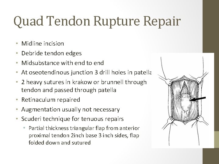 Quad Tendon Rupture Repair Midline incision Debride tendon edges Midsubstance with end to end Quad Tendon Rupture Repair Midline incision Debride tendon edges Midsubstance with end to end