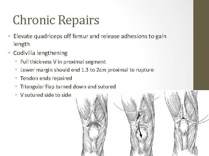 Chronic Repairs • Elevate quadriceps off femur and release adhesions to gain length • Chronic Repairs • Elevate quadriceps off femur and release adhesions to gain length •