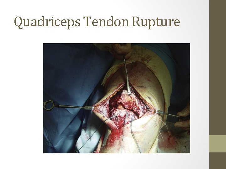 Quadriceps Tendon Rupture Quadriceps Tendon Rupture