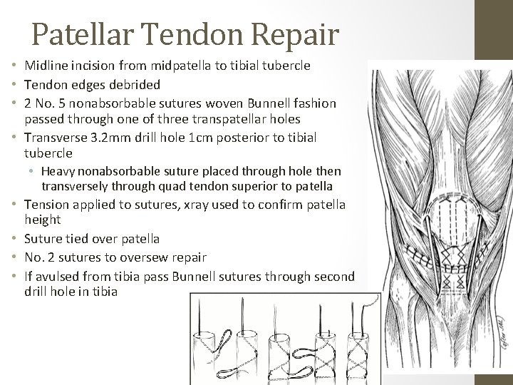 Patellar Tendon Repair • Midline incision from midpatella to tibial tubercle • Tendon edges Patellar Tendon Repair • Midline incision from midpatella to tibial tubercle • Tendon edges