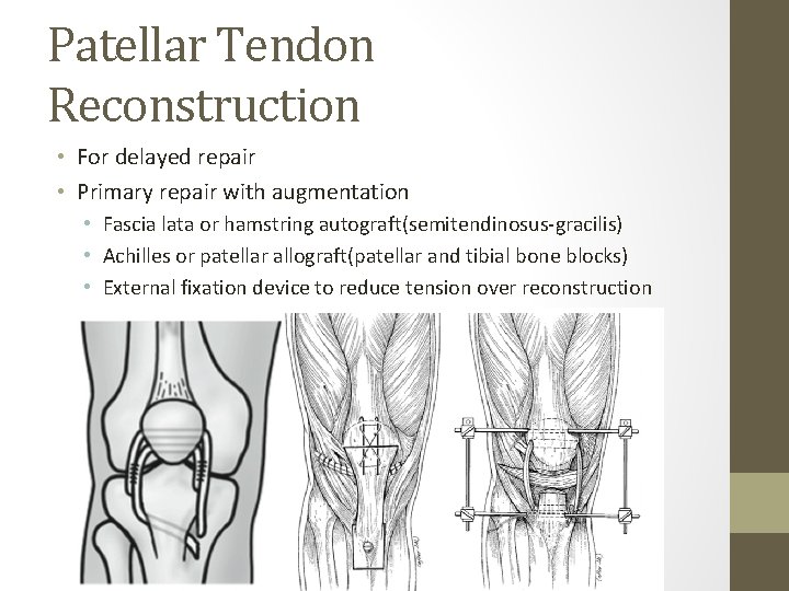 Patellar Tendon Reconstruction • For delayed repair • Primary repair with augmentation • Fascia Patellar Tendon Reconstruction • For delayed repair • Primary repair with augmentation • Fascia