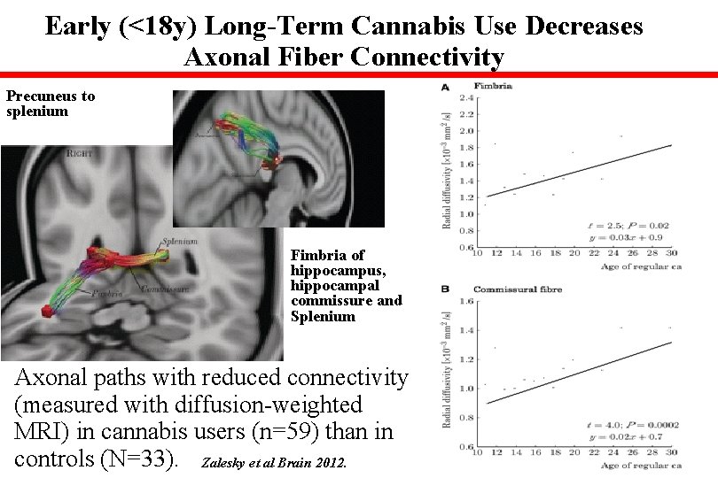 Early (<18 y) Long-Term Cannabis Use Decreases Axonal Fiber Connectivity Precuneus to splenium Fimbria
