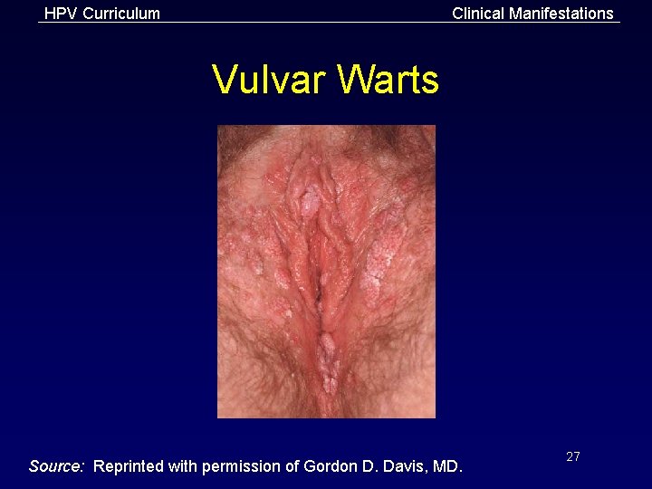 HPV Curriculum Clinical Manifestations Vulvar Warts Source: Reprinted with permission of Gordon D. Davis,