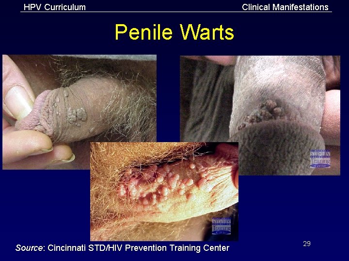 HPV Curriculum Clinical Manifestations Penile Warts Source: Cincinnati STD/HIV Prevention Training Center 29 