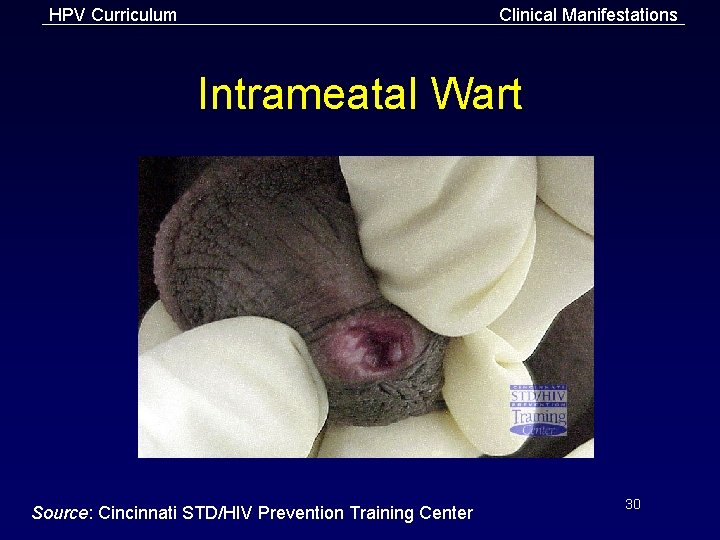 HPV Curriculum Clinical Manifestations Intrameatal Wart Source: Cincinnati STD/HIV Prevention Training Center 30 