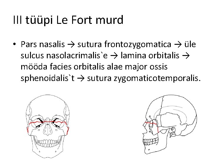 III tüüpi Le Fort murd • Pars nasalis → sutura frontozygomatica → üle sulcus