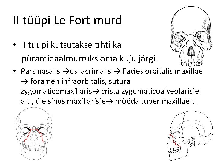 II tüüpi Le Fort murd • II tüüpi kutsutakse tihti ka püramidaalmurruks oma kuju