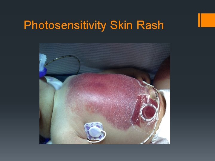 Photosensitivity Skin Rash 
