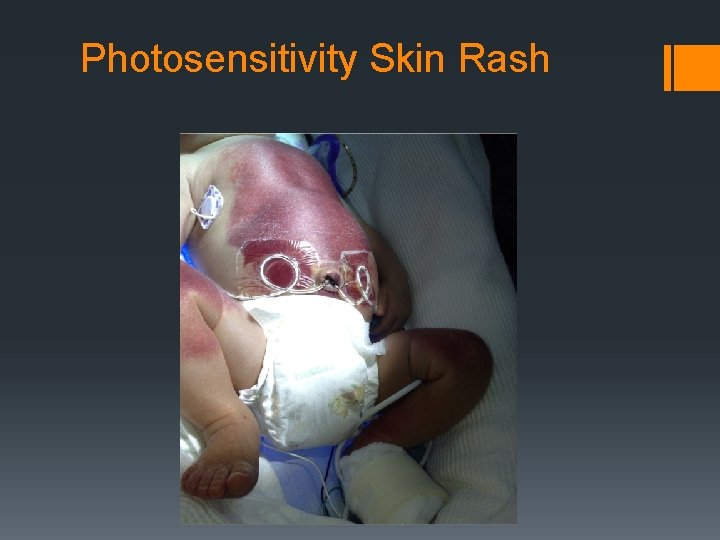 Photosensitivity Skin Rash 
