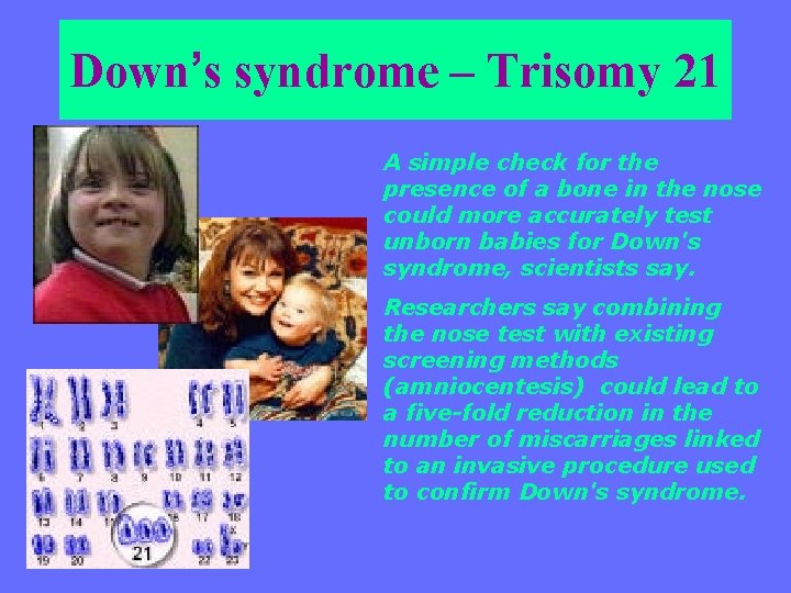 Down’s syndrome – Trisomy 21 A simple check for the presence of a bone