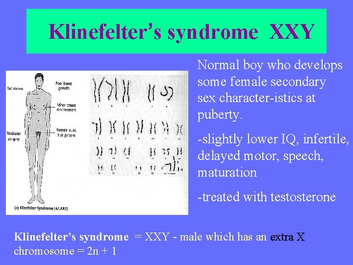 Klinefelter’s syndrome XXY Normal boy who develops some female secondary sex character-istics at puberty.