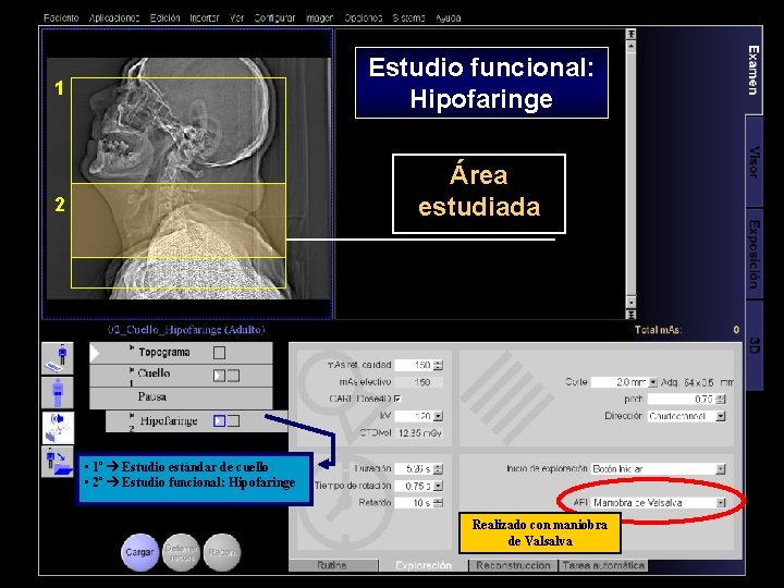 Estudio funcional: Hipofaringe 1 Área estudiada 2 • 1º Estudio estándar de cuello •