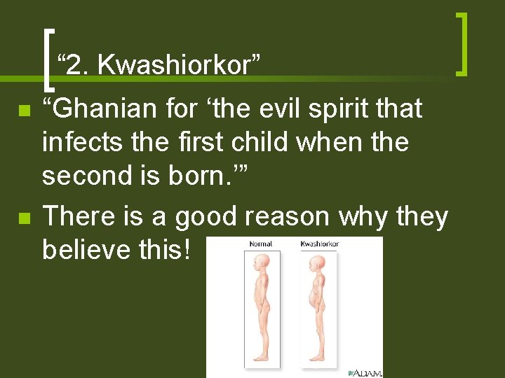 “ 2. Kwashiorkor” n n “Ghanian for ‘the evil spirit that infects the first