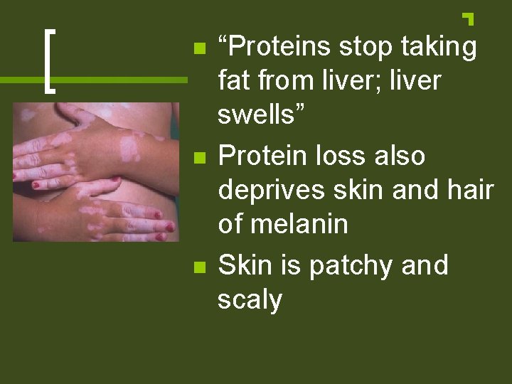 n n n “Proteins stop taking fat from liver; liver swells” Protein loss also