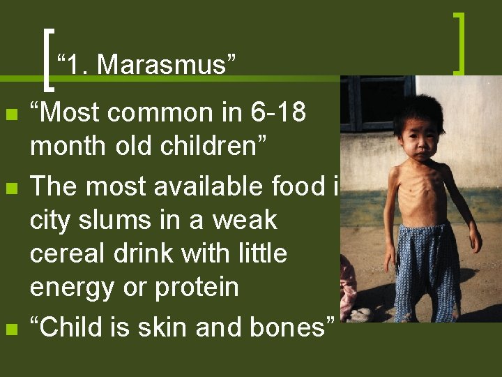 “ 1. Marasmus” n n n “Most common in 6 -18 month old children”