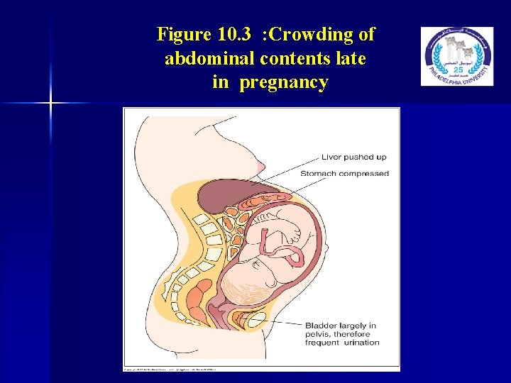 Figure 10. 3 : Crowding of abdominal contents late in pregnancy Figure 10. 3 : Crowding of abdominal contents late in pregnancy