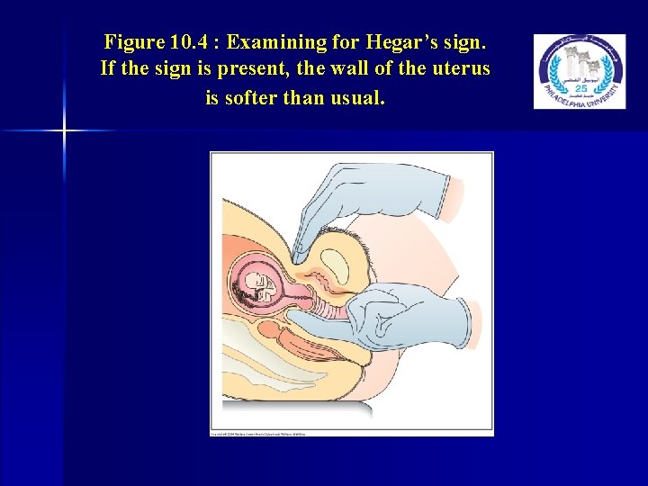 Figure 10. 4 : Examining for Hegar’s sign. If the sign is present, the