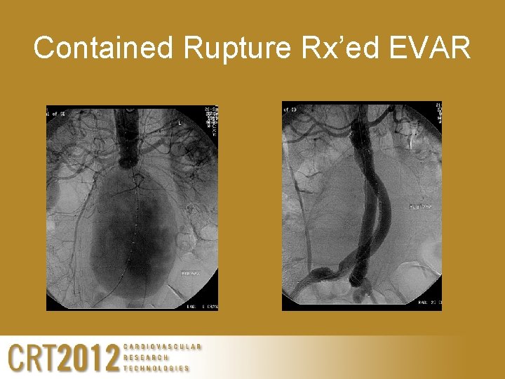 Contained Rupture Rx’ed EVAR 