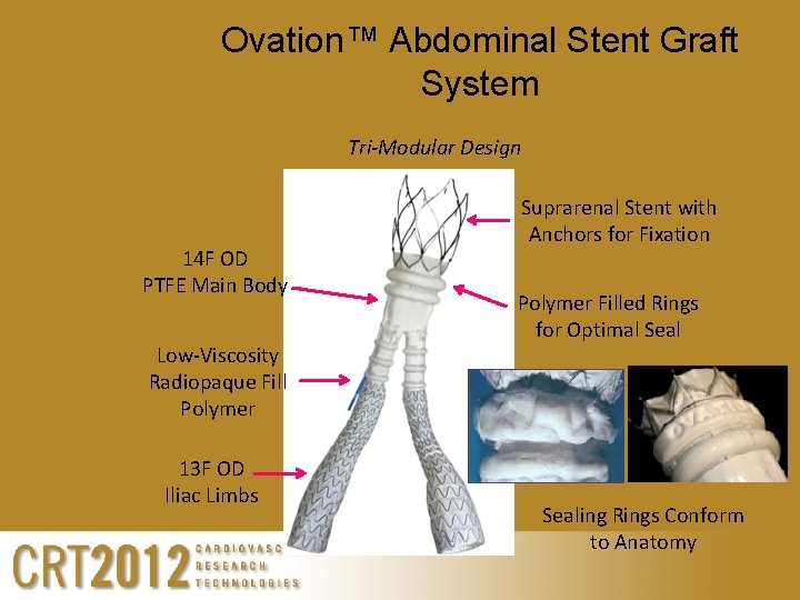 Ovation™ Abdominal Stent Graft System Tri-Modular Design 14 F OD PTFE Main Body Low-Viscosity