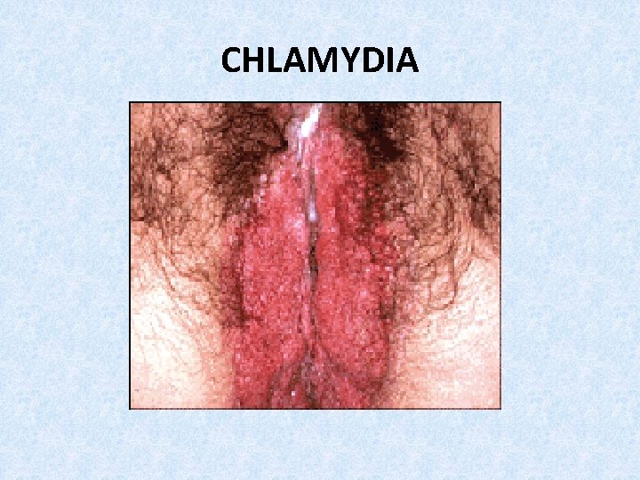 CHLAMYDIA 