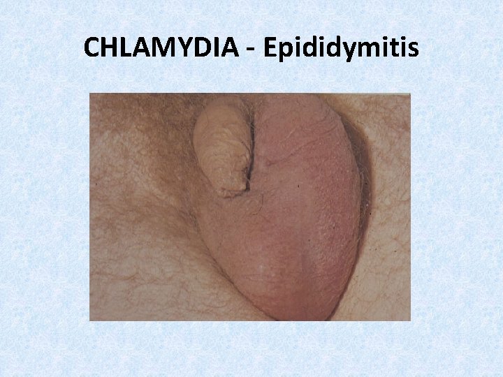 CHLAMYDIA - Epididymitis 