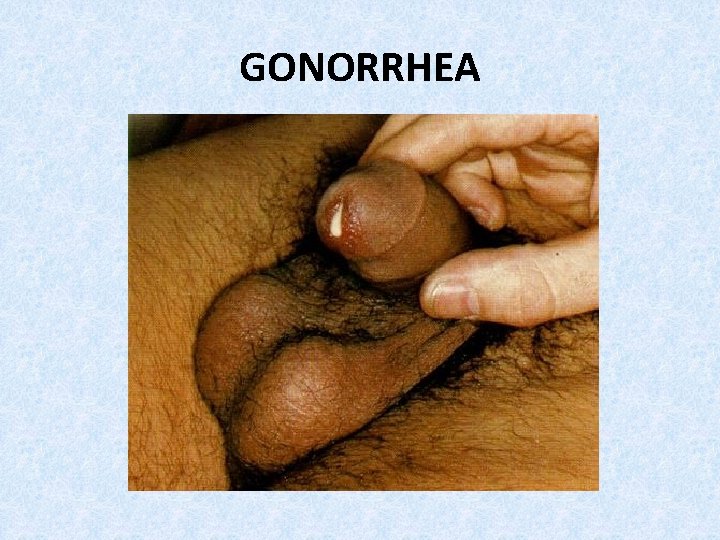 GONORRHEA 
