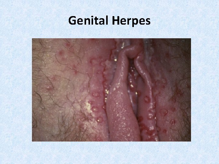 Genital Herpes 
