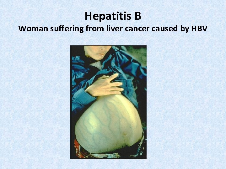 Hepatitis B Woman suffering from liver cancer caused by HBV 