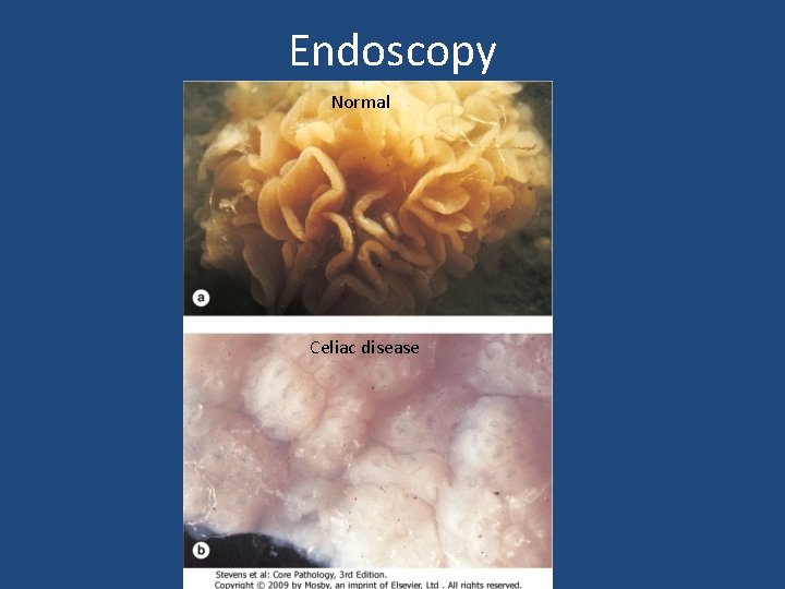 Endoscopy Normal Celiac disease 