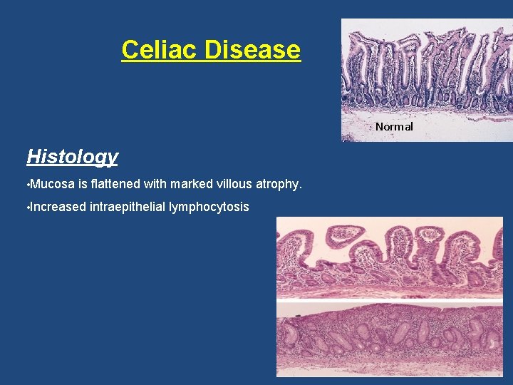 Celiac Disease Normal Histology • Mucosa is flattened with marked villous atrophy. • Increased