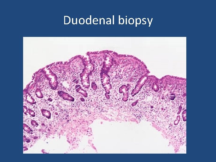 Duodenal biopsy 