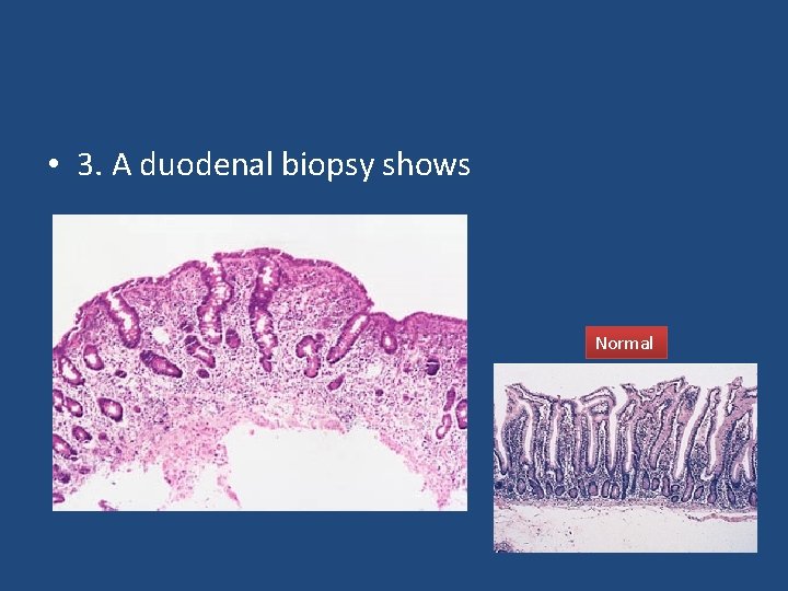  • 3. A duodenal biopsy shows Normal 