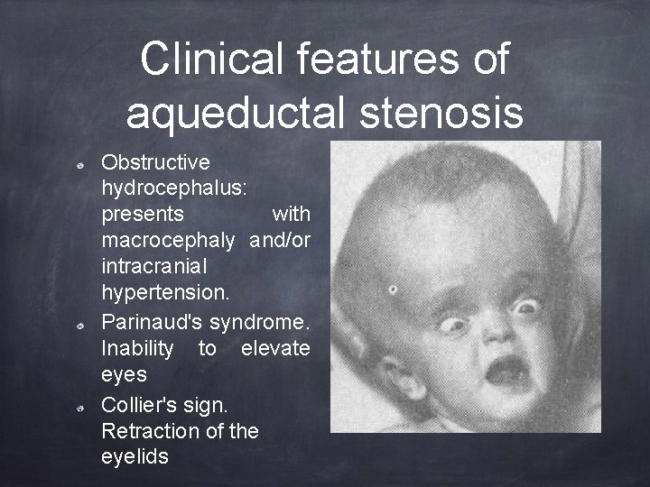 Clinical features of aqueductal stenosis Obstructive hydrocephalus: presents with macrocephaly and/or intracranial hypertension. Parinaud's