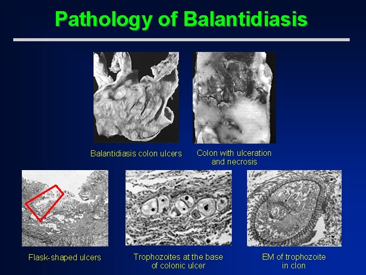 Pathology of Balantidiasis colon ulcers Flask-shaped ulcers Colon with ulceration and necrosis Trophozoites at
