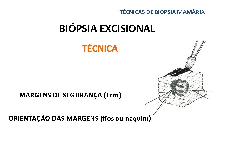 TÉCNICAS DE BIÓPSIA MAMÁRIA BIÓPSIA EXCISIONAL TÉCNICA MARGENS DE SEGURANÇA (1 cm) ORIENTAÇÃO DAS