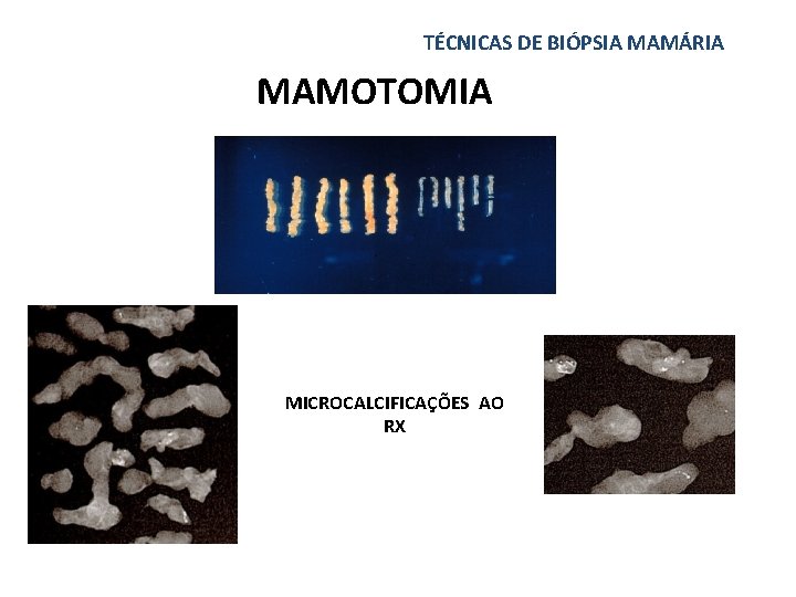 TÉCNICAS DE BIÓPSIA MAMÁRIA MAMOTOMIA MICROCALCIFICAÇÕES AO RX 