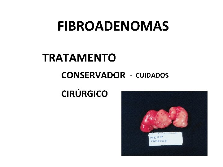 FIBROADENOMAS TRATAMENTO CONSERVADOR CIRÚRGICO - CUIDADOS 