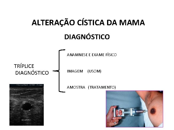 ALTERAÇÃO CÍSTICA DA MAMA DIAGNÓSTICO ANAMNESE E EXAME FÍSICO TRÍPLICE DIAGNÓSTICO IMAGEM (USOM) AMOSTRA