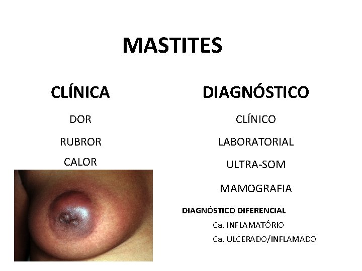 MASTITES CLÍNICA DIAGNÓSTICO DOR CLÍNICO RUBROR LABORATORIAL CALOR ULTRA-SOM MAMOGRAFIA DIAGNÓSTICO DIFERENCIAL Ca. INFLAMATÓRIO