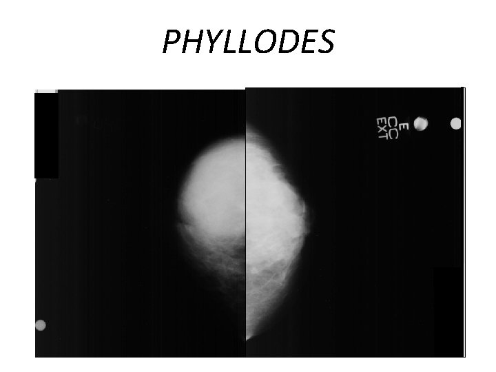 PHYLLODES MAMOGRAFIA SEMELHANTE OUTRAS LESÕES CIRCUNSCRITA MARGENS PODEM SER OBSCURECIDAS AUSÊNCIA DE LESÕES ESPICULADAS