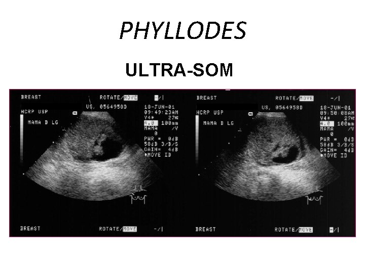 PHYLLODES ULTRA-SOM 
