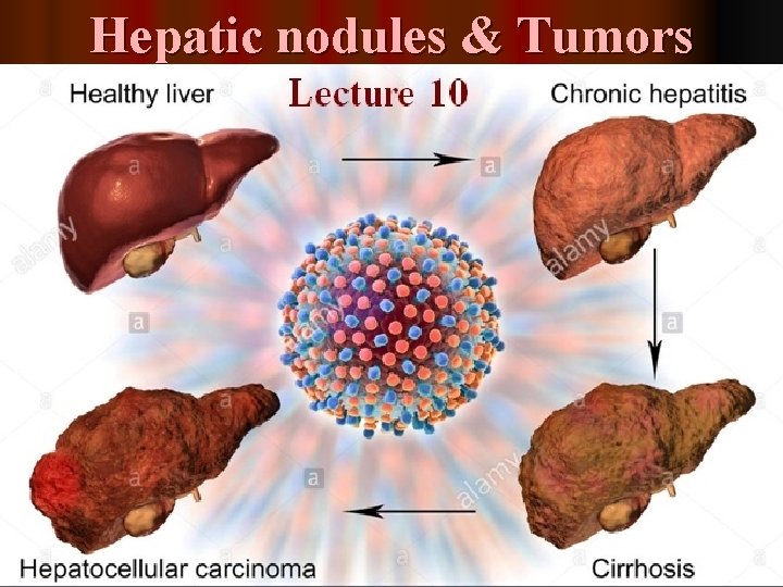 Hepatic nodules & Tumors Lecture 10 