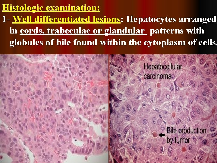 Histologic examination: 1 - Well differentiated lesions: Hepatocytes arranged in cords, trabeculae or glandular