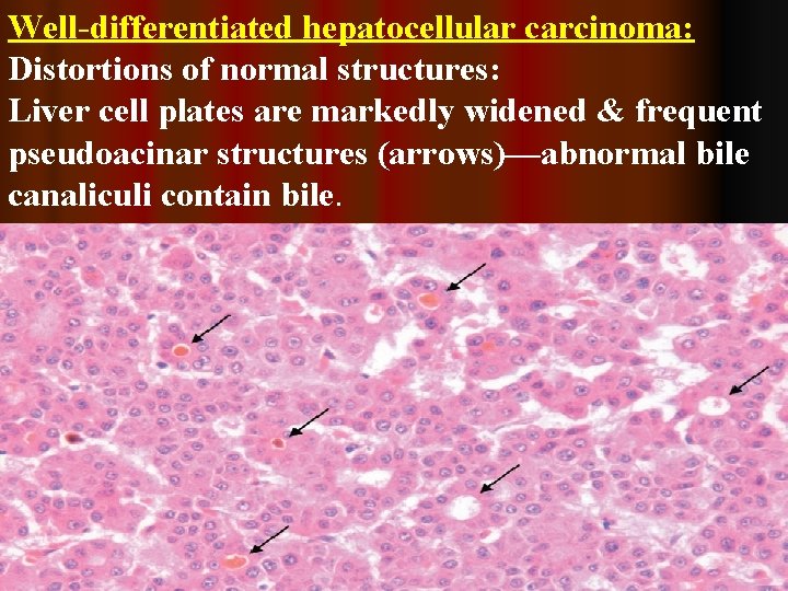 Well-differentiated hepatocellular carcinoma: Distortions of normal structures: Liver cell plates are markedly widened &