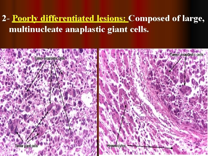 2 - Poorly differentiated lesions: Composed of large, multinucleate anaplastic giant cells. 