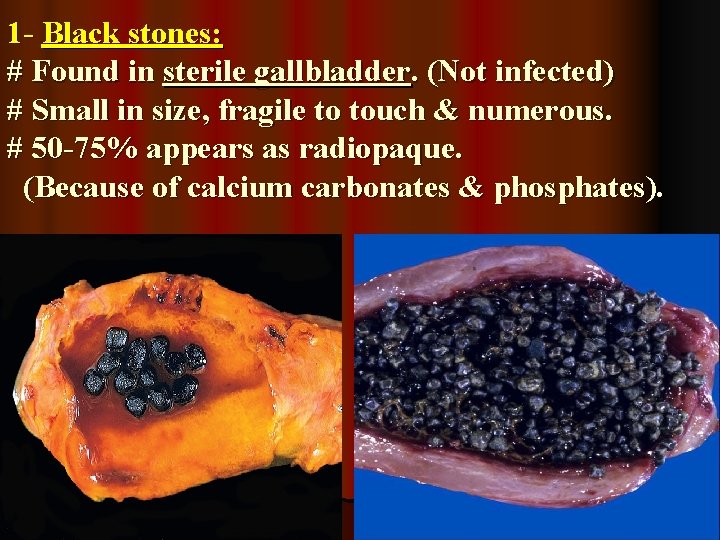 1 - Black stones: # Found in sterile gallbladder. (Not infected) # Small in