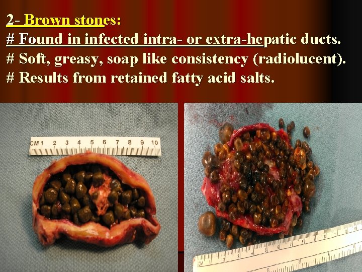 2 - Brown stones: # Found in infected intra- or extra-hepatic ducts. # Soft,