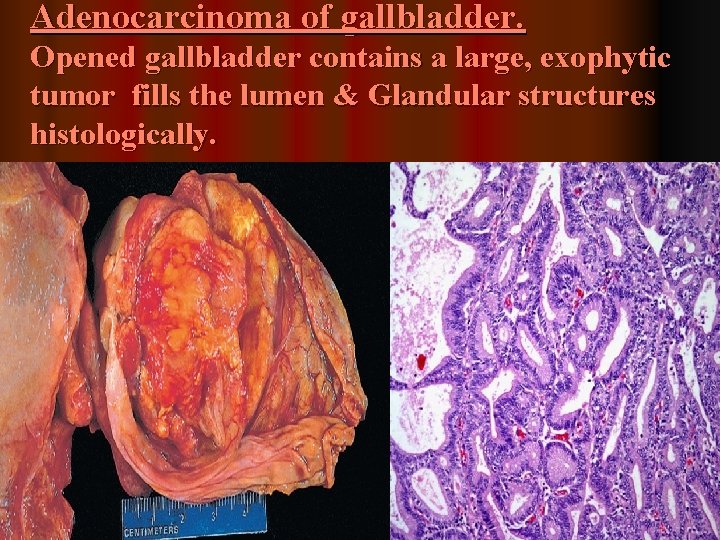 Adenocarcinoma of gallbladder. Opened gallbladder contains a large, exophytic tumor fills the lumen &