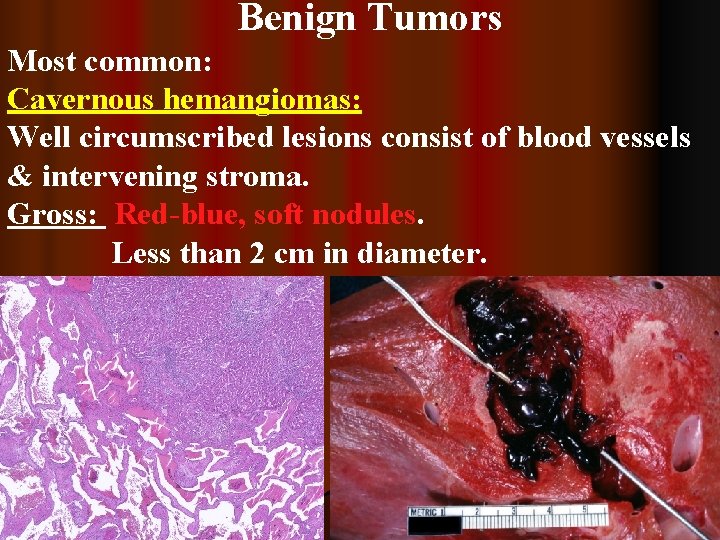 Benign Tumors Most common: Cavernous hemangiomas: Well circumscribed lesions consist of blood vessels &